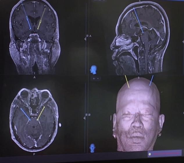 MRIのデータをもとに決定された、2本の電極の位置を示す画像。電極の先端が前頭葉を通過して、脳の表面から30mm前後に位置する視床下核に到達しているのが確認できる。